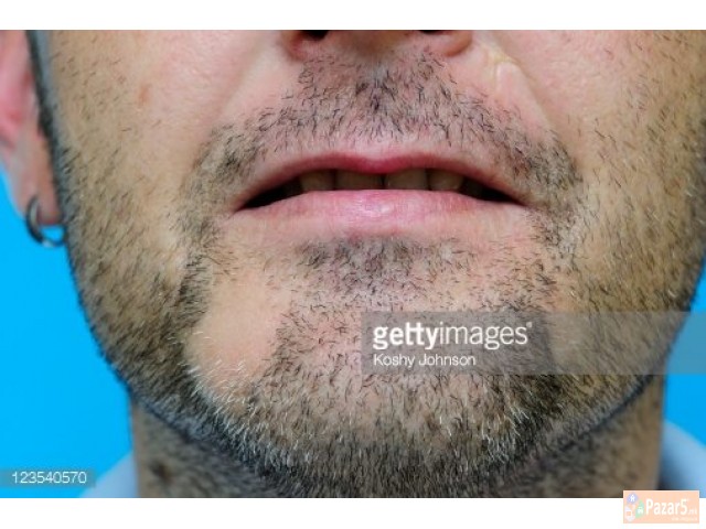 Лекување од Косопас (alopecia Areata)