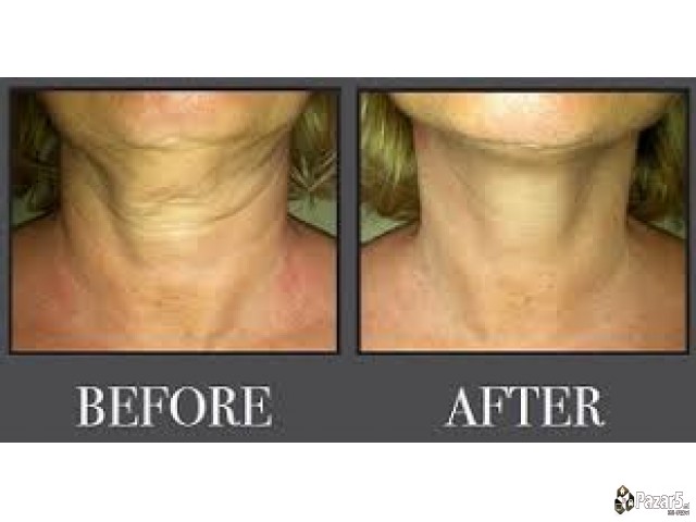 НОВО! Природна АНТИРИД КРЕМА од пчелин отров