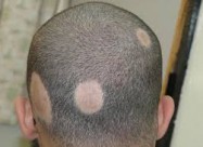 Лекување од Косопас (alopecia Areata)